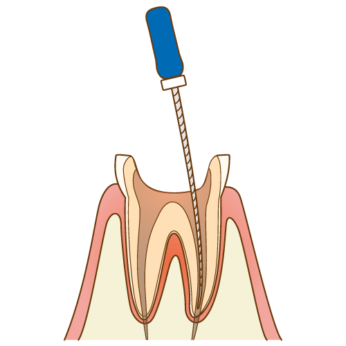 根管治療とは？