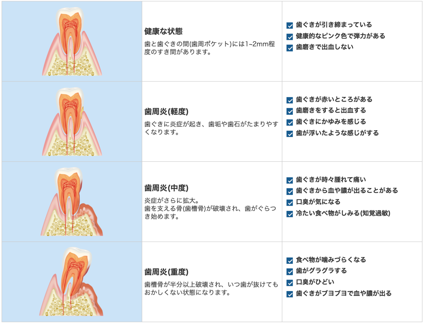 歯周病の進行度と症状