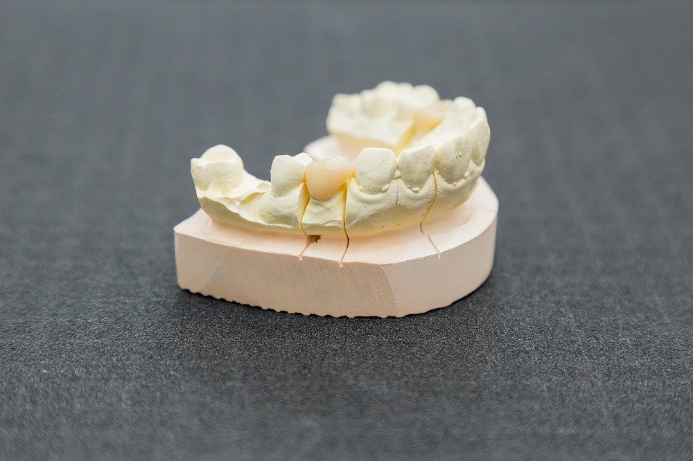 コンピュターで作製する被せ物です