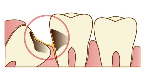 抜歯した方が良い親知らず