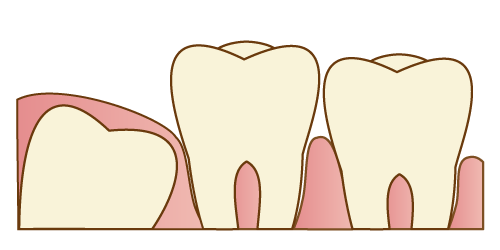 抜歯しなくても良い親知らず