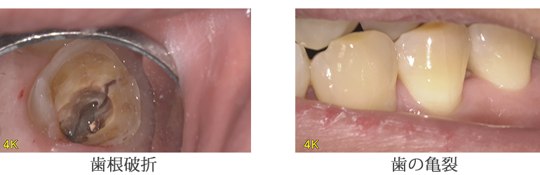 根管（歯の根っこの中）の奥までしっかり診察が可能
