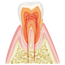歯周炎（軽度）