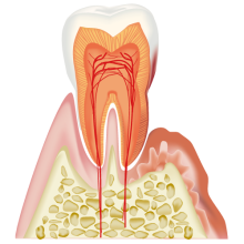 歯周炎（中度）