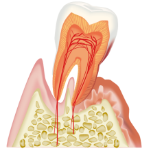 歯周病（重度）